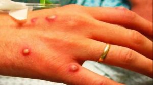 ИЈЗ: За прв пат во Македонија откриени се двајца пациенти болни од Мајмунски сипаници